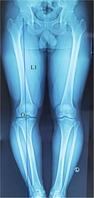 Application of SolidWorks software in preoperative planning of high tibial osteotomy